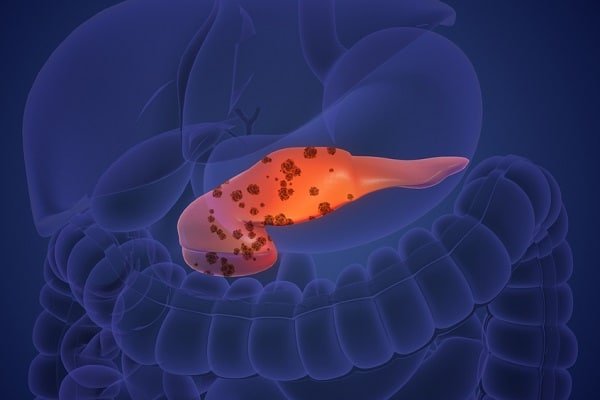 3D medical illustration of the digestive system with the pancreas highlighted in orange.
