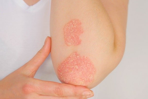 Close-up of an arm elbow with two red, scaly eczema patches on the skin, being touched gently by the other hand.