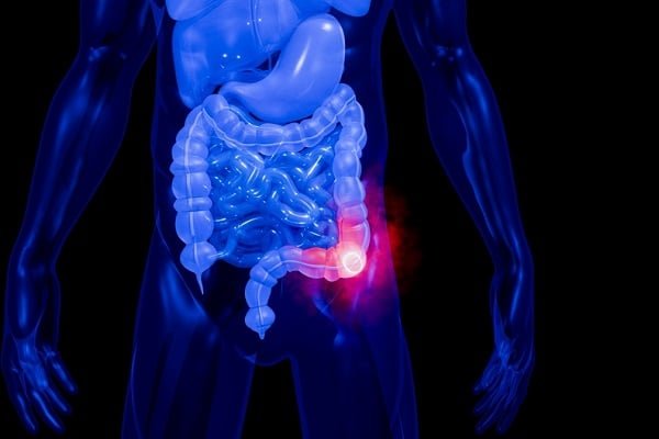 Medical illustration of a translucent human torso showing the large intestine, with a red glow at the lower abdomen indicating pain in that area