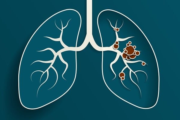 Illustration of the lungs showing tumor nodules in the right lung in brown color.
