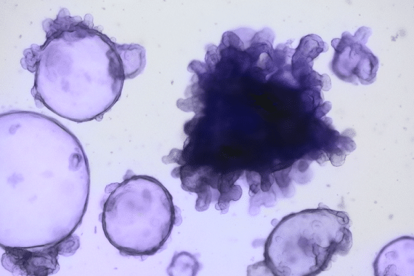 Purple-stained cells under a microscope; a large dark irregular cluster surrounded by round cells.