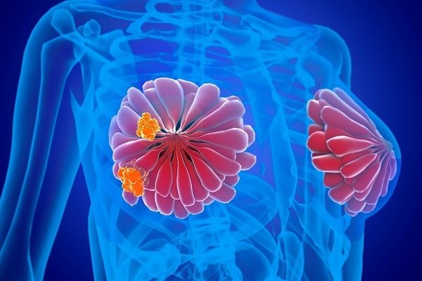 Medical illustration of a female chest showing two breasts with orange tumor growths on the left breast, highlighting cancerous lesions.